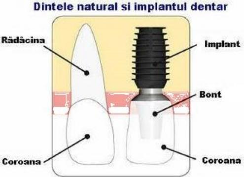 Implanturi dentare Bicon made in USA de la Cabinet Stomatologie Implantologie Dr. Leca Eduard