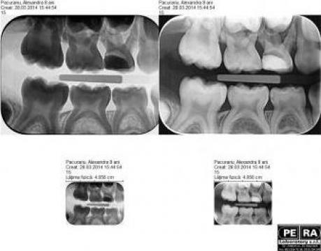 Radiografii intraorale RX digitale interproximale X2, X4 de la Petra Laboratory - Centrul De Radiologie Digitala Stomatolog